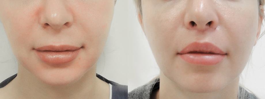 Metamorfoza - Lip Lift