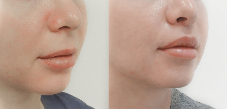 Metamorfoza - Lip Lift