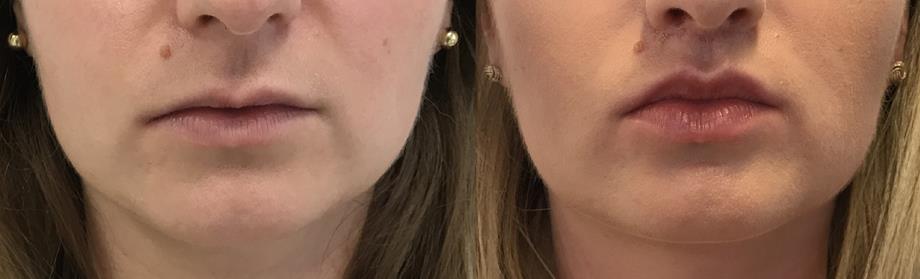 Metamorfoza - Lip Lift
