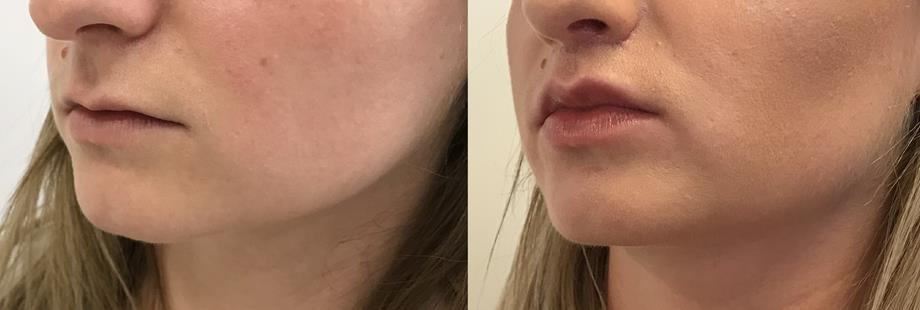 Metamorfoza - Lip Lift