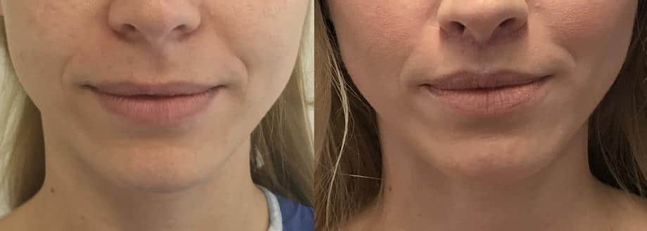Metamorfoza - Lip Lift