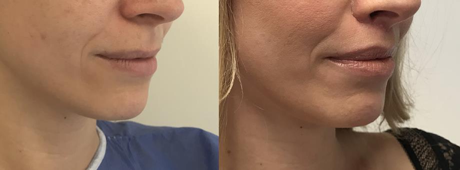 Metamorfoza - Lip Lift