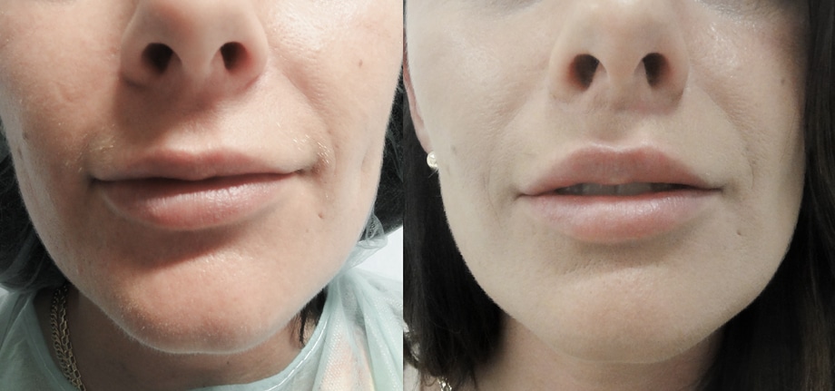 Metamorfoza - Lip Lift