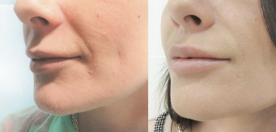 Metamorfoza - Lip Lift