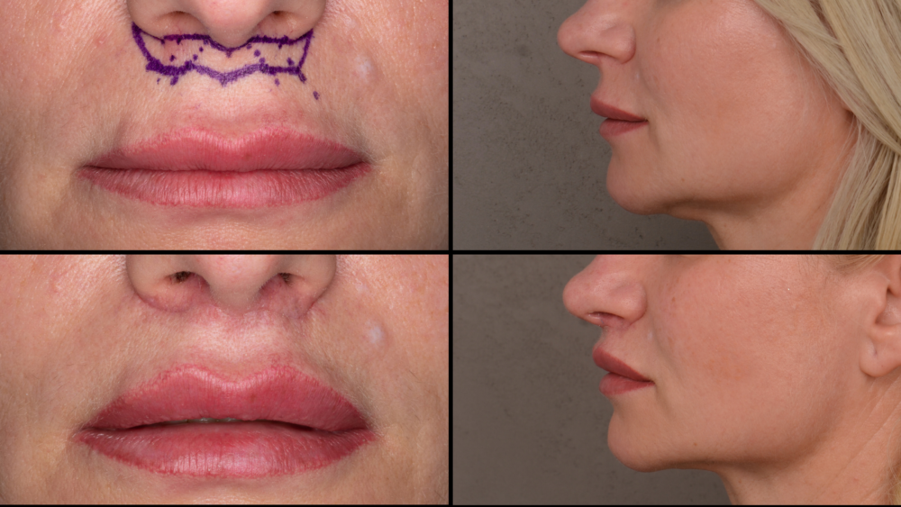 Metamorfoza - Lip Lift