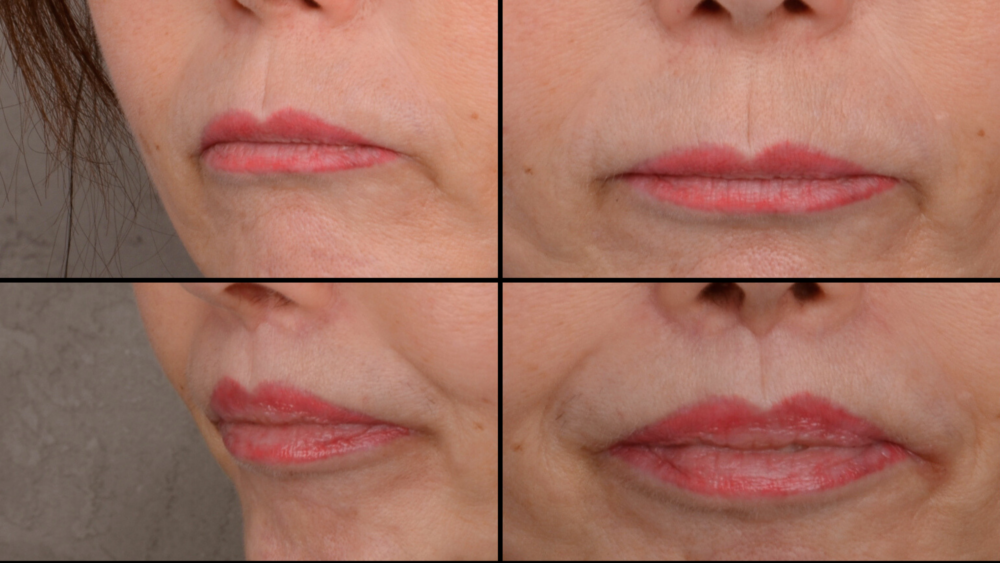 Metamorfoza - Lip Lift