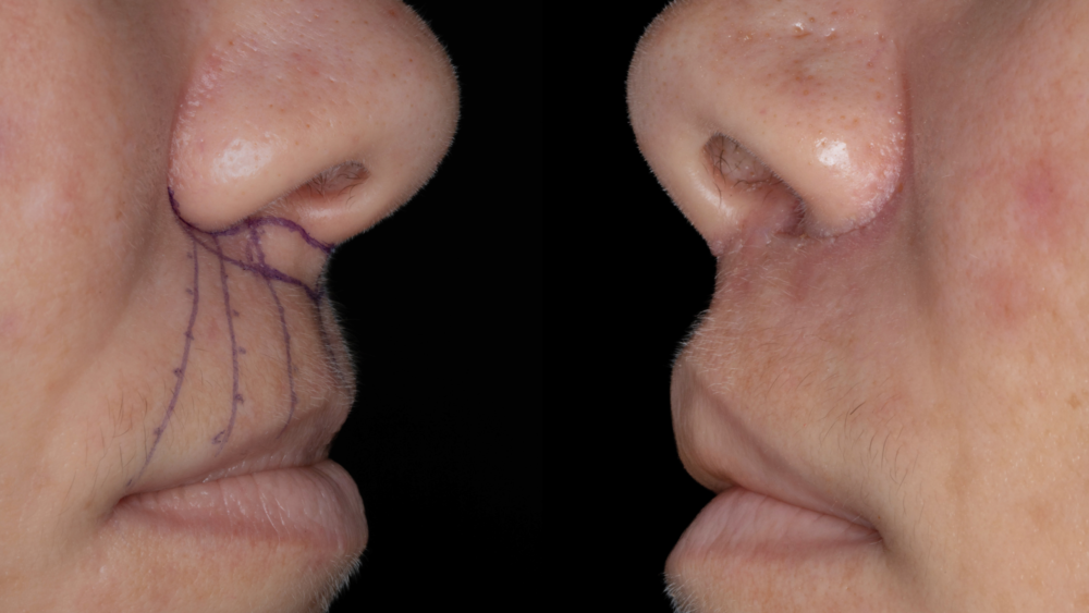 Metamorfoza - Lip Lift