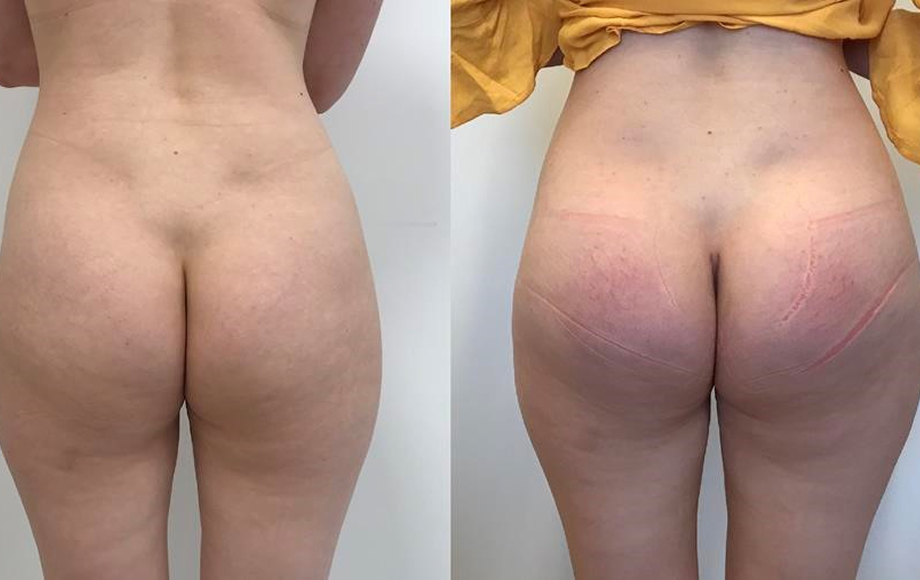Powiększanie pośladków za pomocą implantów 9 p2a Copy