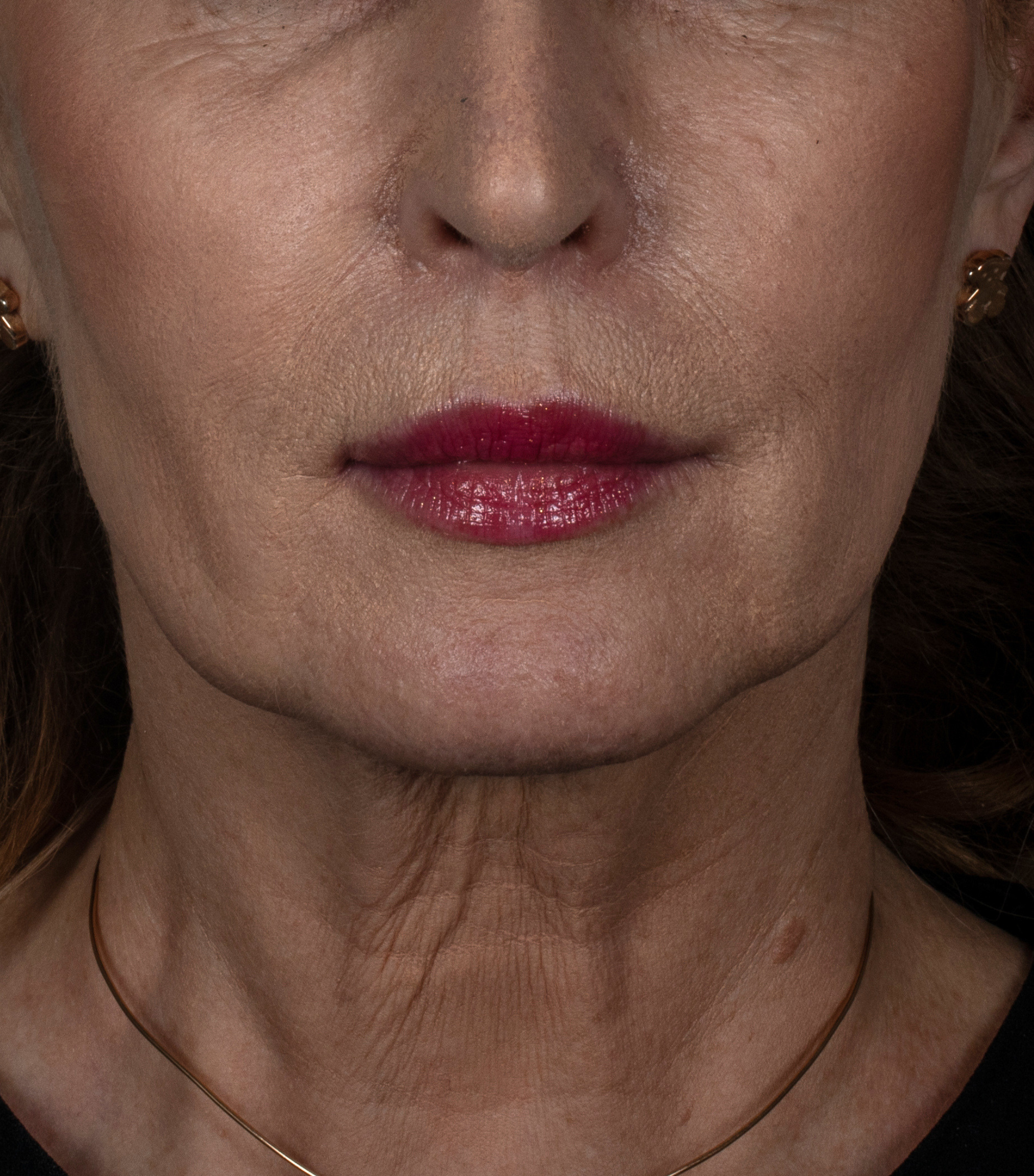 dr n. med. Jakub Bargiel 7 Facelift 1