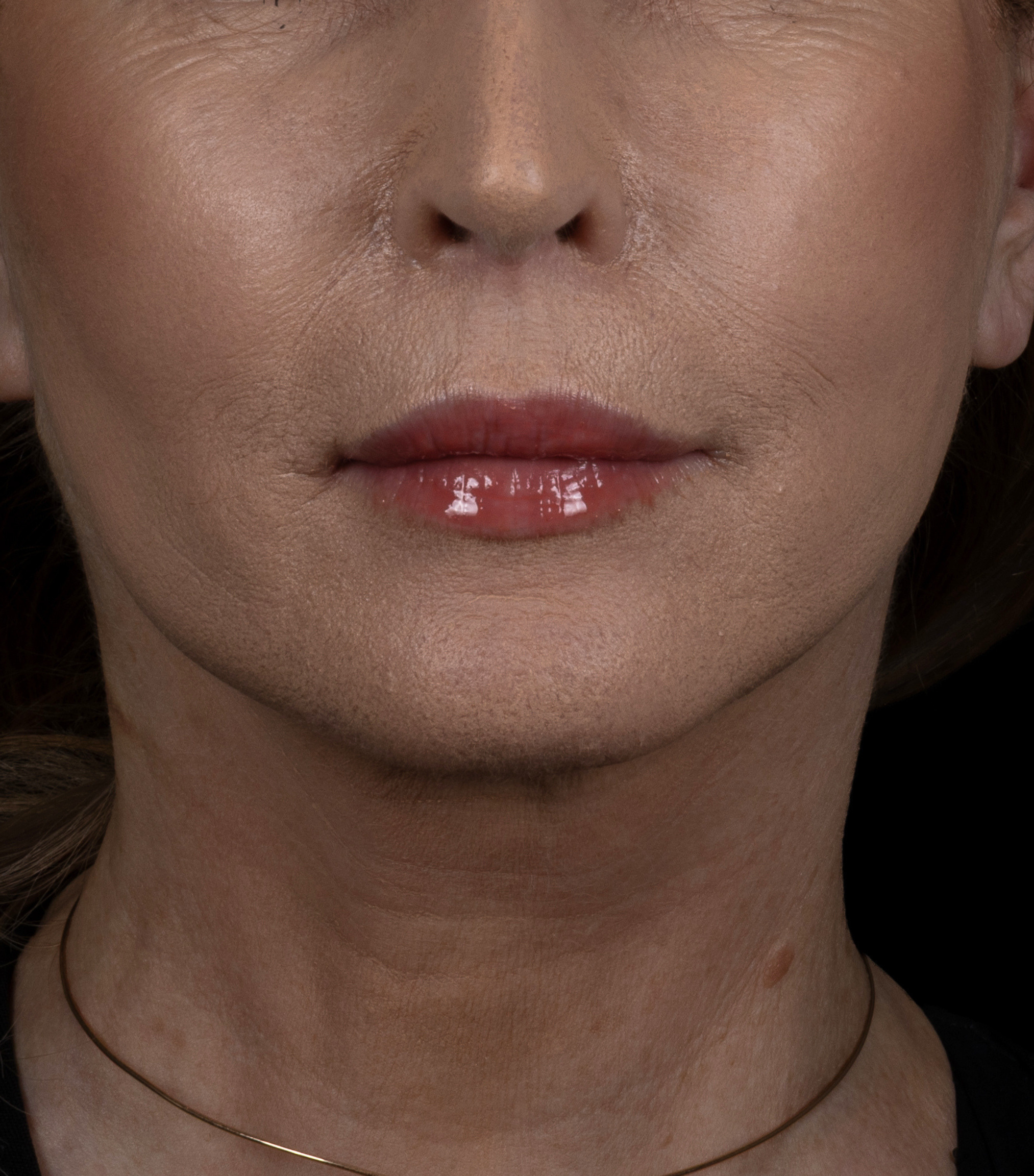 dr n. med. Jakub Bargiel 6 Facelift 2