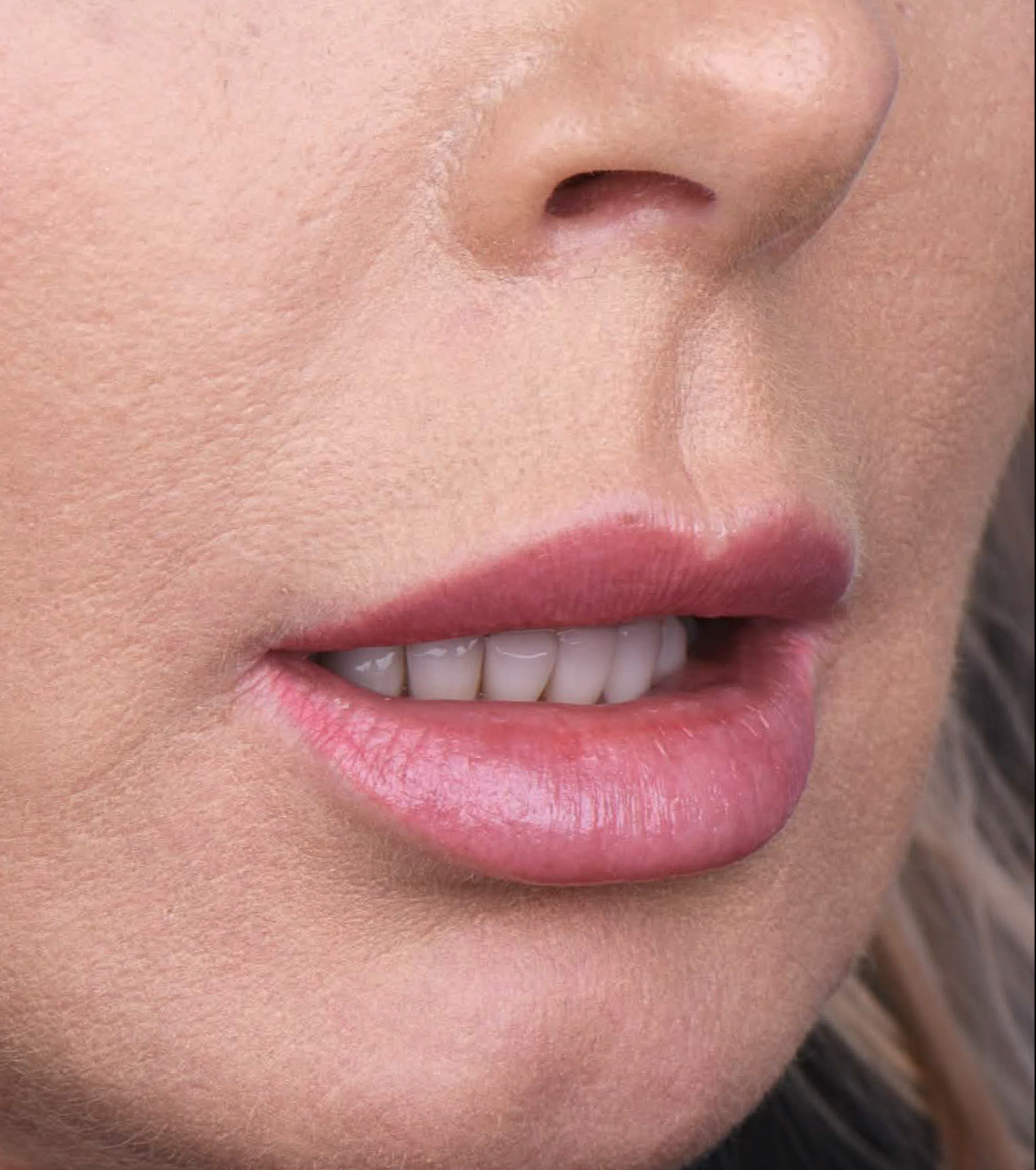dr n. med. Jakub Bargiel 3 dr Bargiel lip lif przed