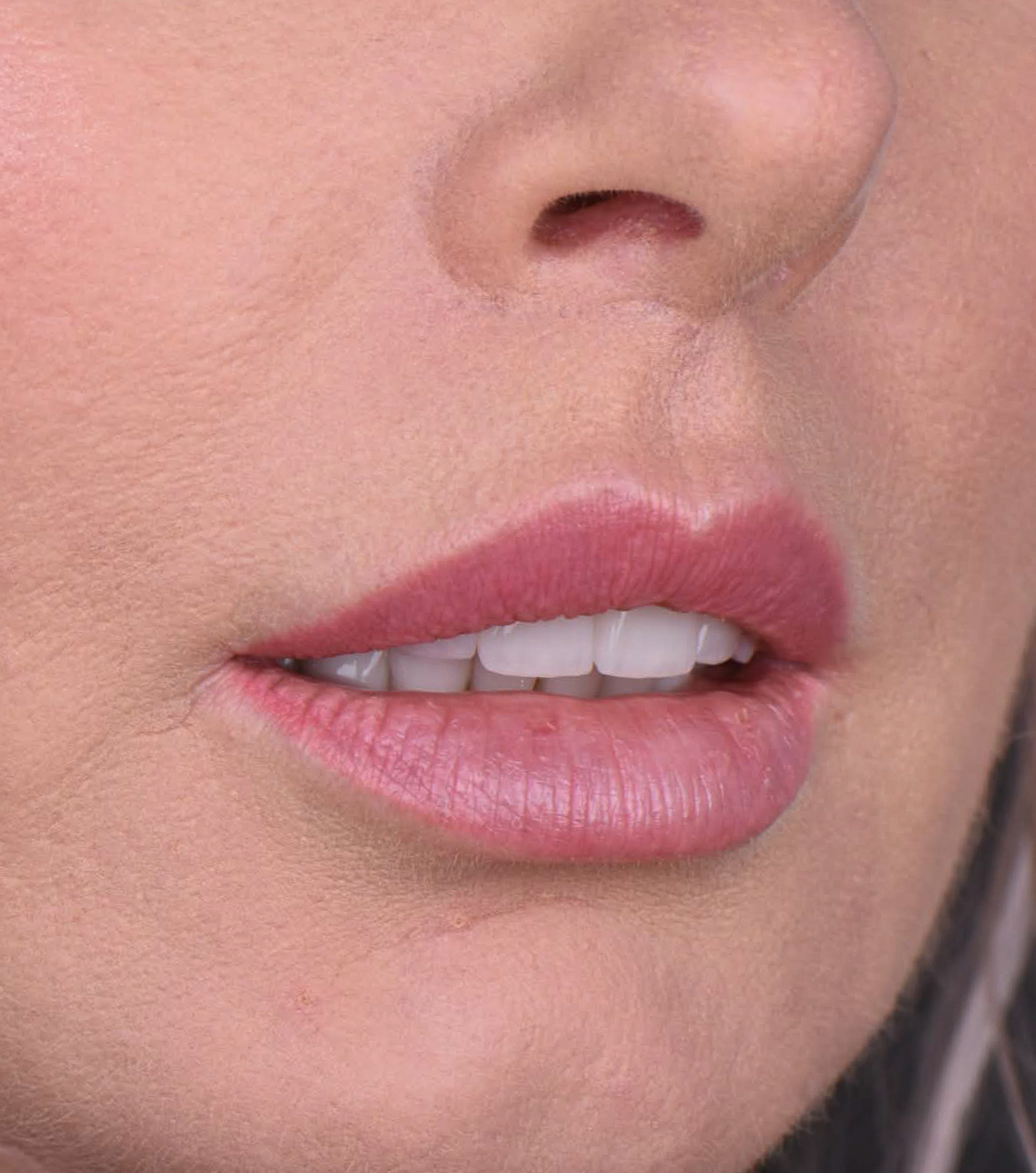 dr n. med. Jakub Bargiel 2 dr bargiel lip lift po