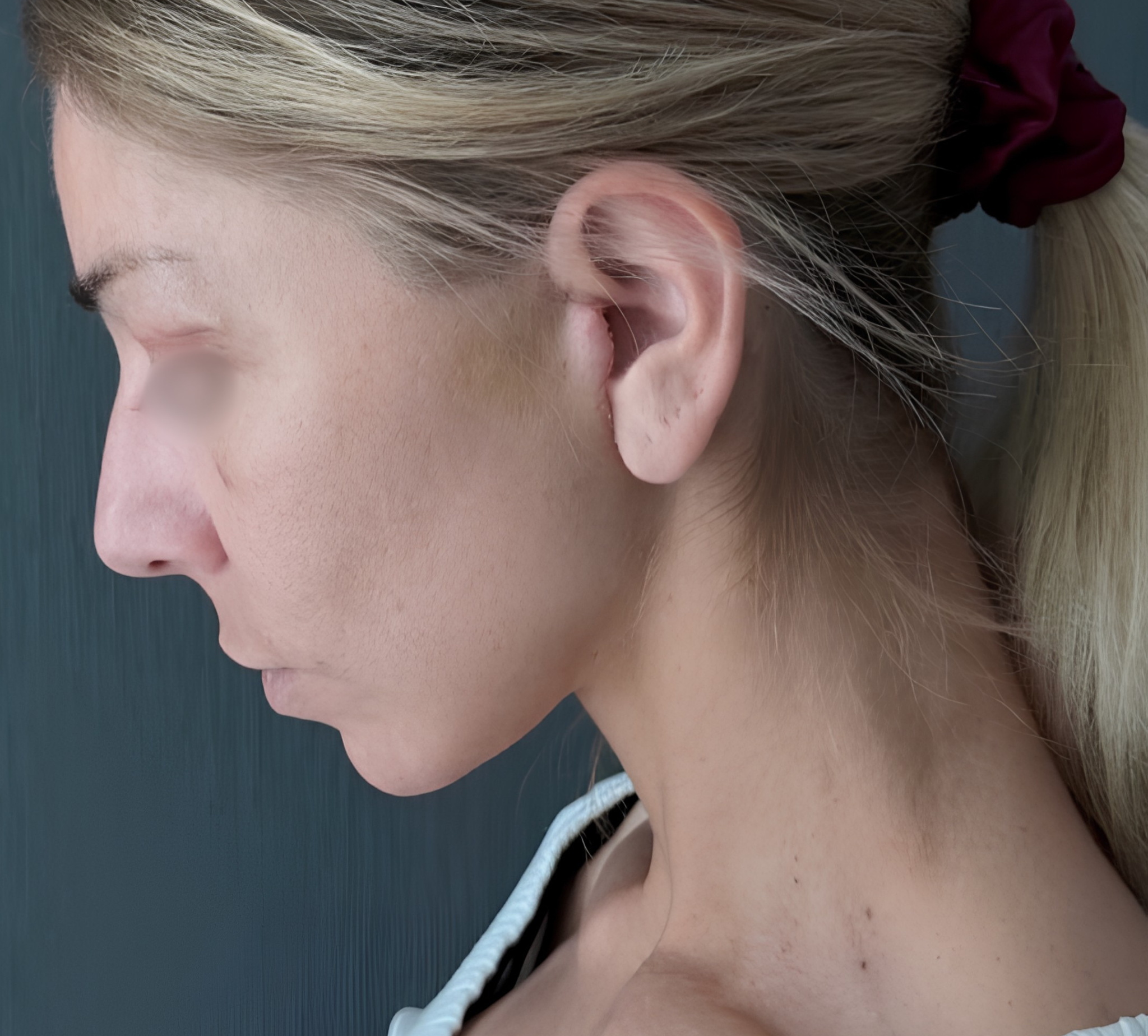 dr.miskiewicz midfacelift po krako
