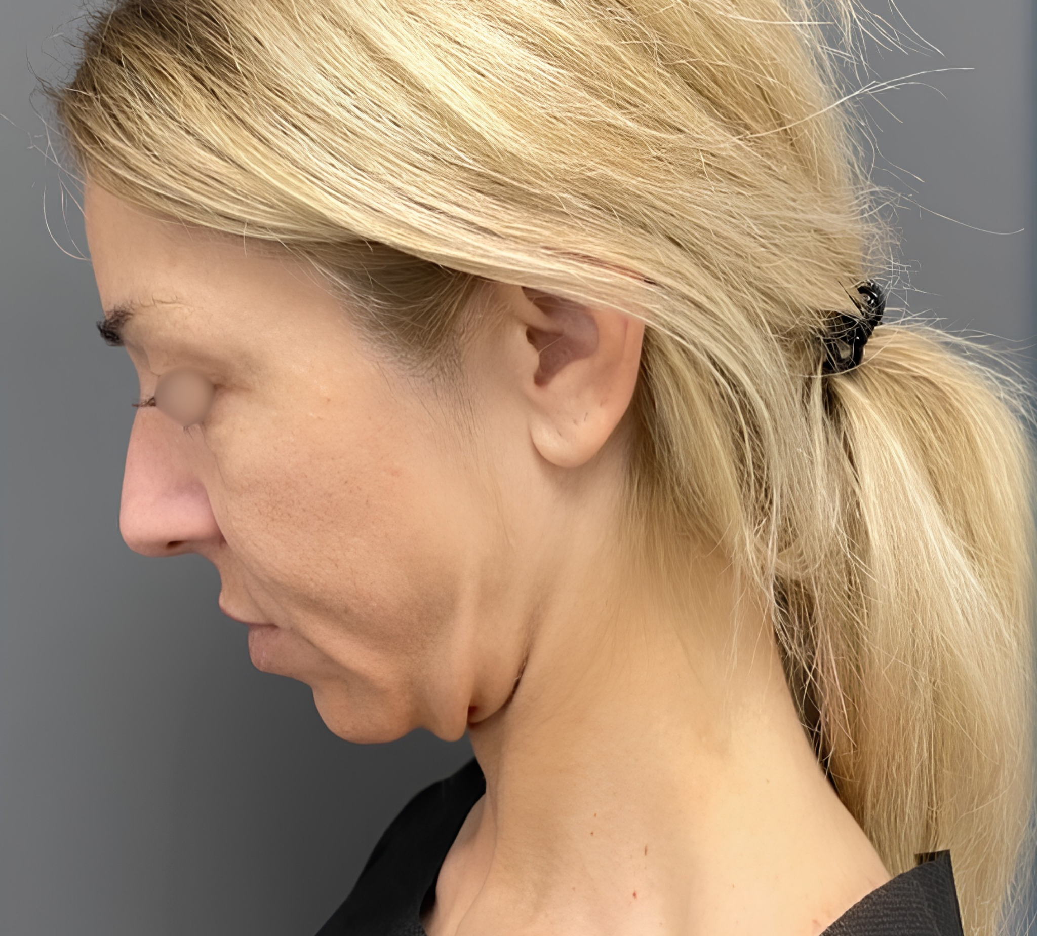 dr.miskiewicz midfacelift przed krakow