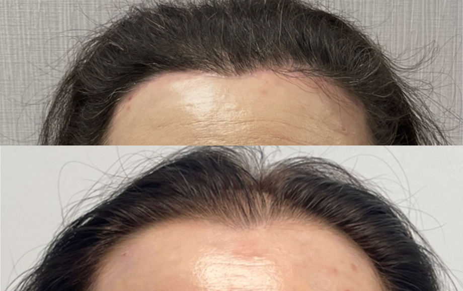 HALO (Hairline Lowering) – obniżenie linii włósów 4 metamorfoza zabieg HALO