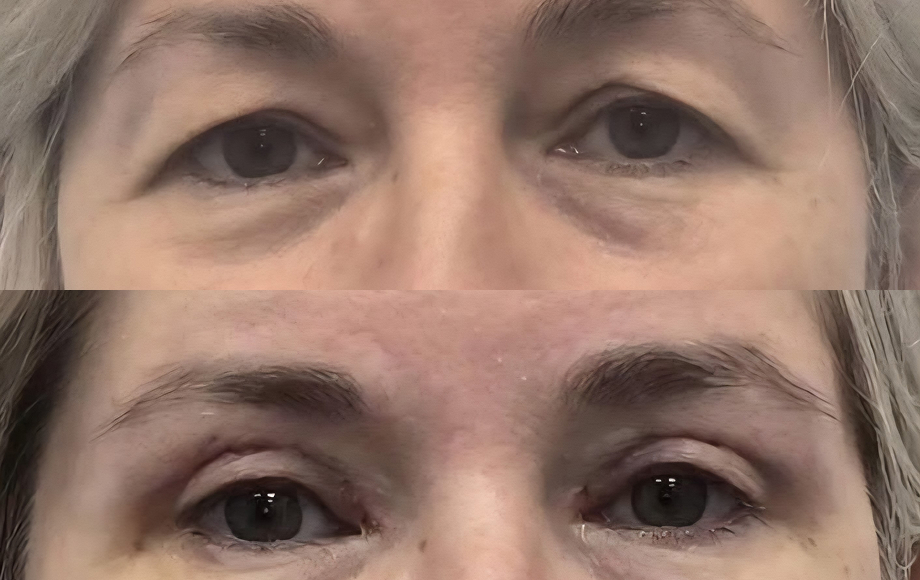 Blefaroplastyka 2 dr Marta Handziak