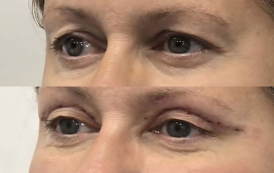 Blefaroplastyka 3 dr Marta Handziak