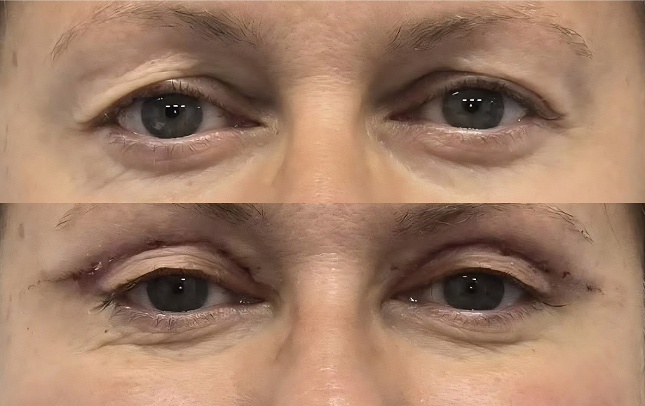 Blefaroplastyka 4 dr Marta Handziak