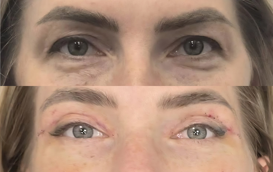 Blefaroplastyka 5 dr Marta Handziak