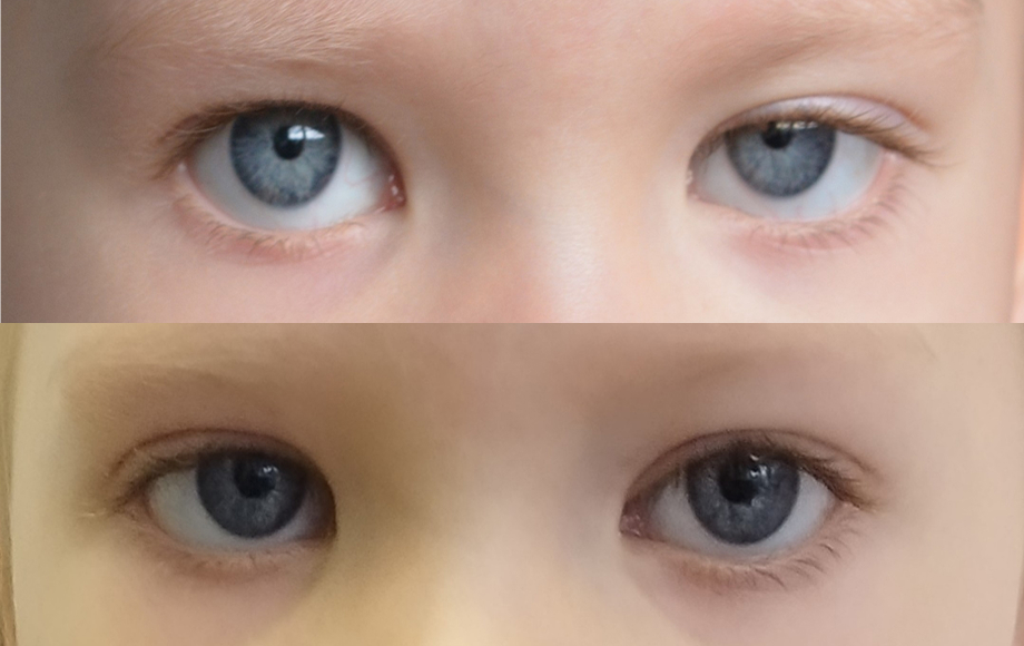 Blefaroplastyka 6 dr Marta Handziak