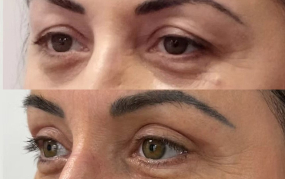 Blefaroplastyka dr Marta Handziak
