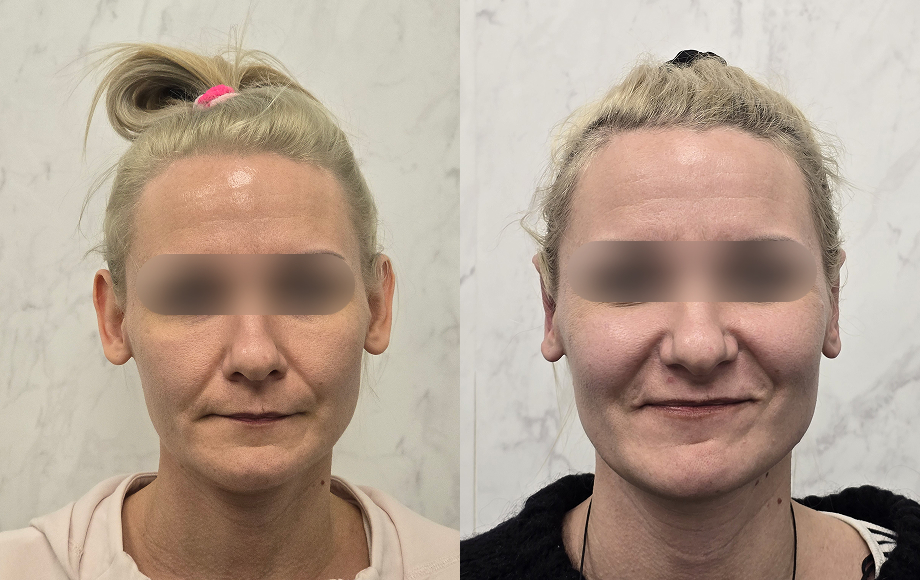 Korekcja plastyczna odstających uszu 28 Korekcja uszu 3 dr Marta Handziak