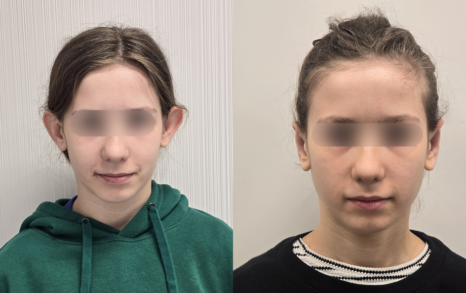 Korekcja plastyczna odstających uszu 26 Korekcja uszu dr Marta Handziak