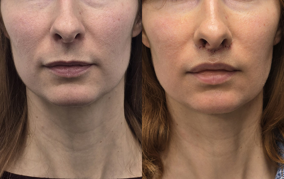 Lip lift 22 Lip lift dr Marta Handziak