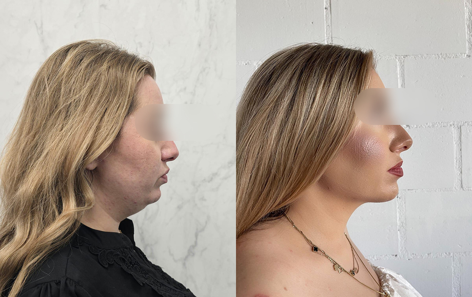 Liposukcja podbródka 10 Liposukcja podbrodka 2 dr Marta Handziak
