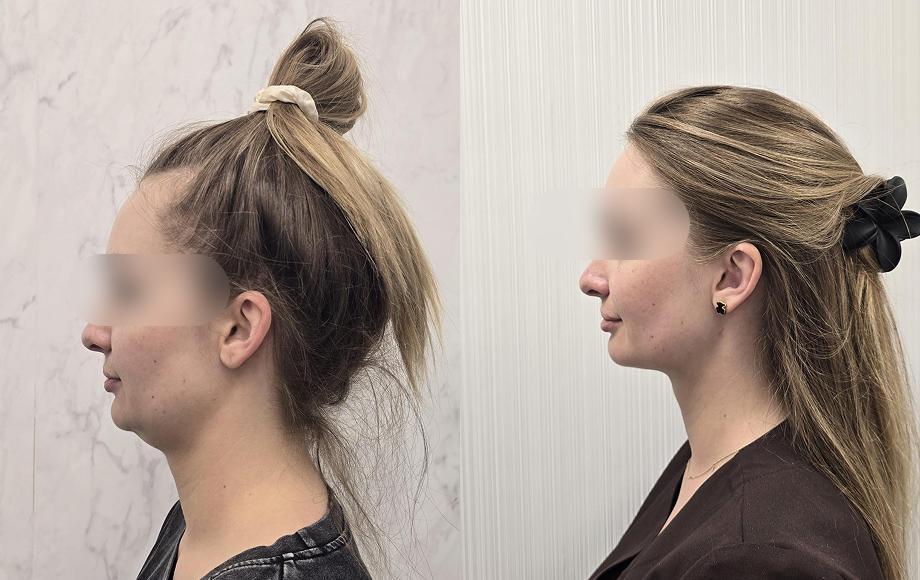 Liposukcja podbródka 11 Liposukcja podbrodka 3 dr Marta Handziak