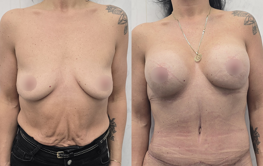 Jednoczesna korekcja piersi z plastyką brzucha (mommy makeover) 16 Mommy makeover dr Marta Handziak