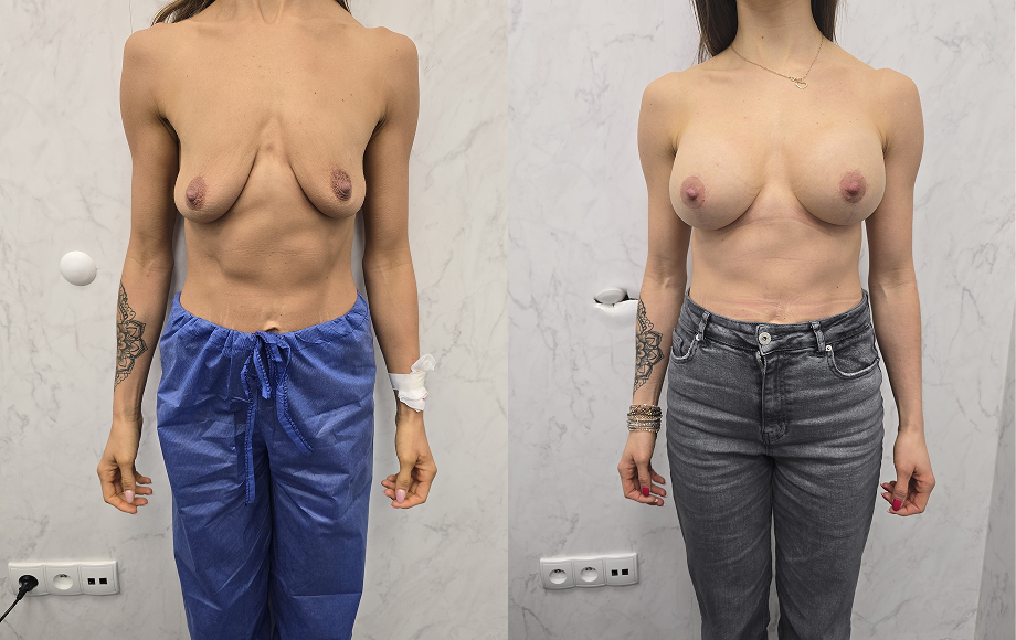 Podniesienie piersi z wszczepieniem implantów 14 Podniesienie piersi dr Marta Handziak