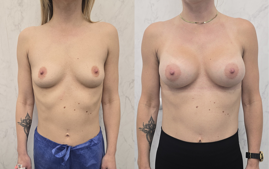 Powiększanie piersi implantami 30 powiekszanie piersi 2 dr Marta Handziak