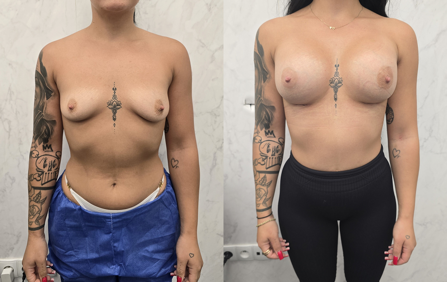 Powiększanie piersi implantami 31 powiekszanie piersi 3 dr Marta Handziak