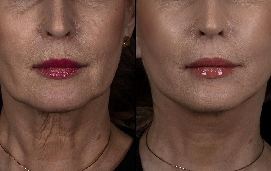 Metamorfoza - Facelift